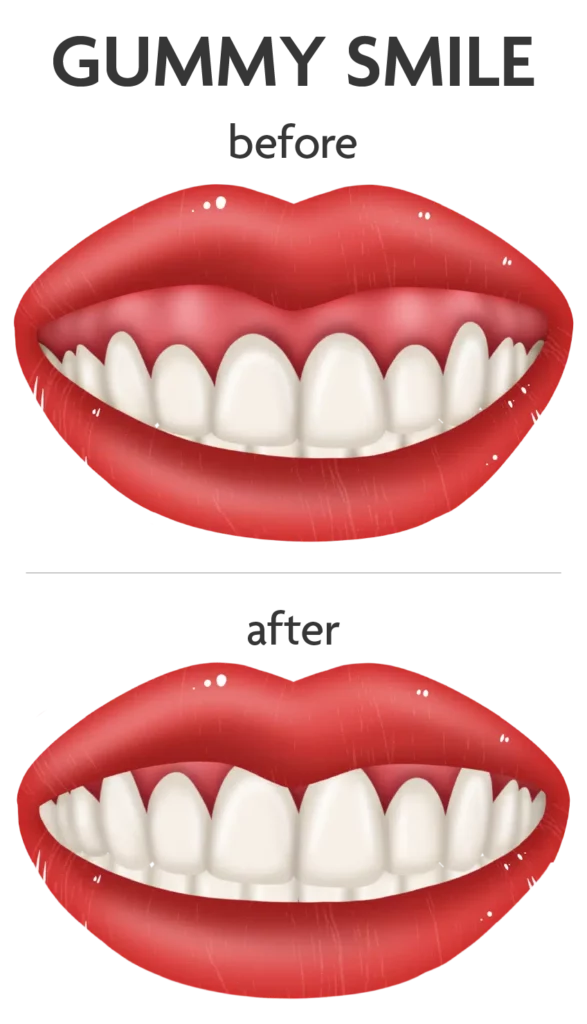 How to fix a gummy smile: here are all your best options both invasive and not