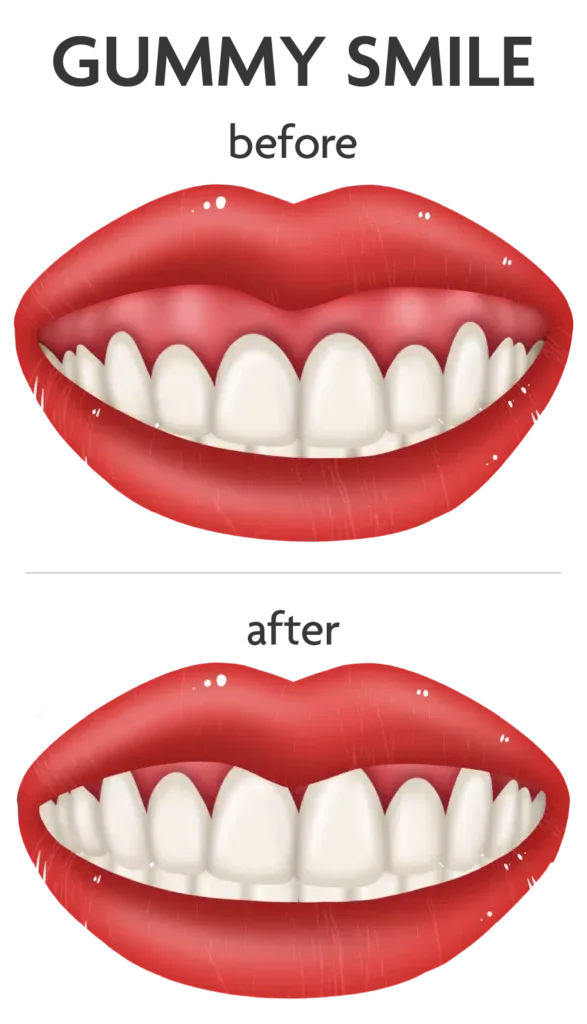 How to fix a gummy smile: here are all your best options both invasive and not