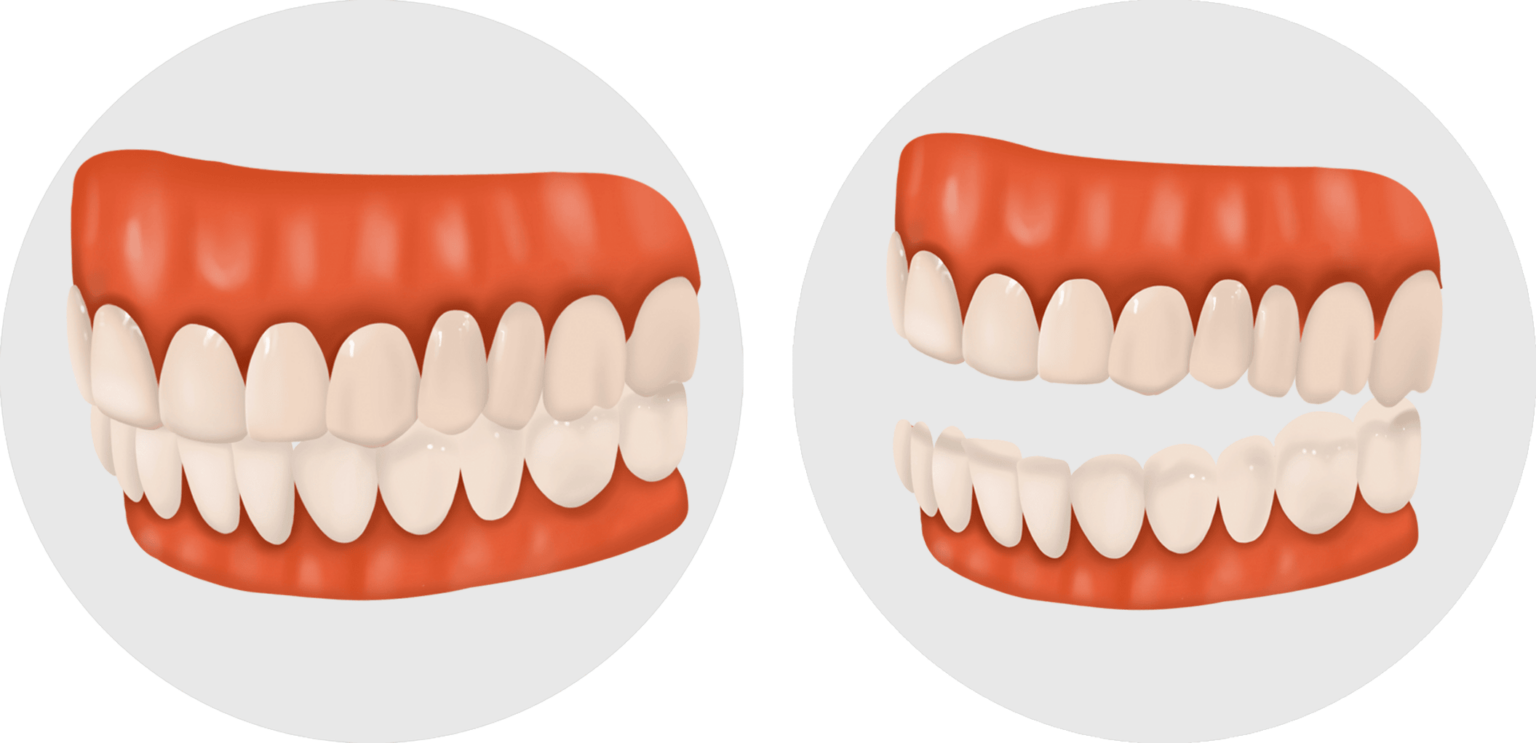 My bite is off after crown, is it normal?