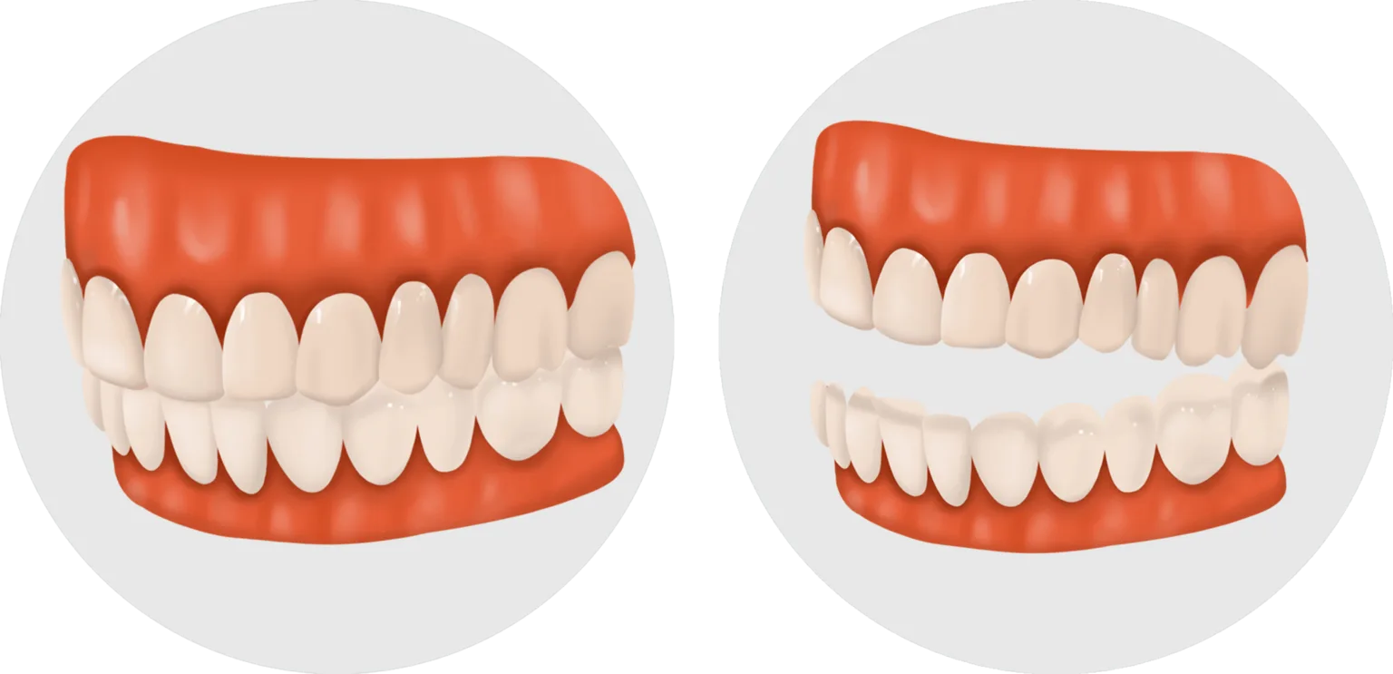 My bite is off after crown, is it normal?