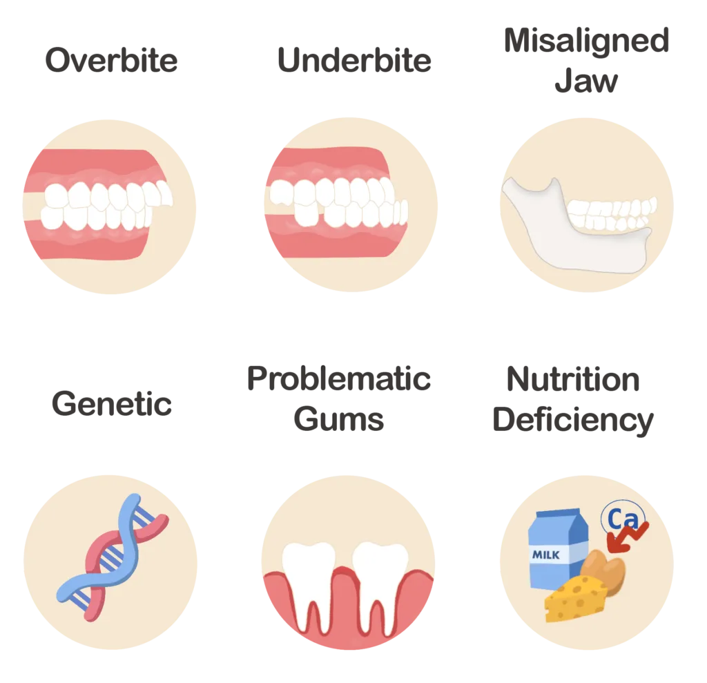 What causes crooked teeth?: possible reasons listed!