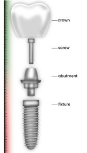 What to do if a dental implant falls out: a short guide for you!