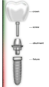 What to do if a dental implant falls out: a short guide for you!