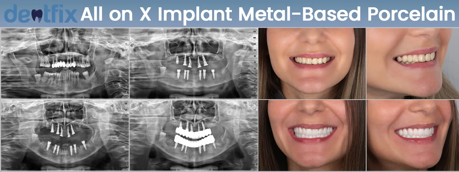 All-on-4 / All-on-6 full-mouth implant before and after — X-ray and smile, Dentfix Istanbul