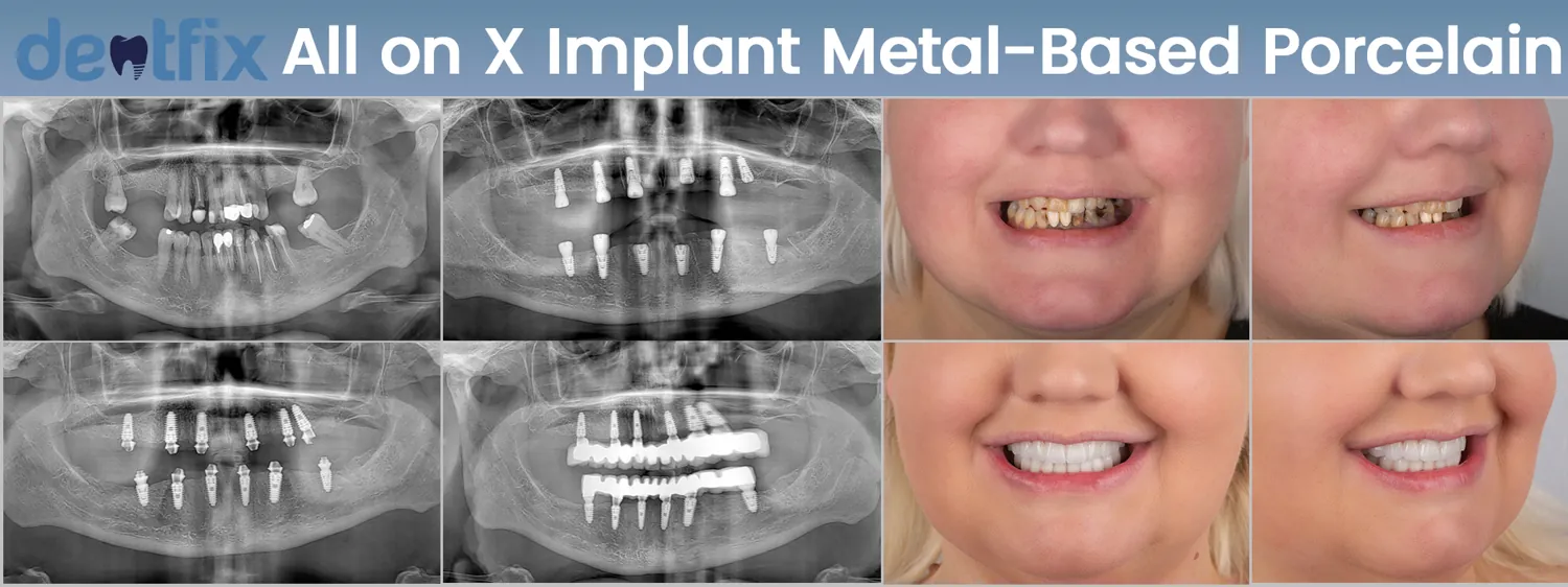 All-on-4 / All-on-6 full-mouth implant before and after — X-ray and smile, Dentfix Istanbul