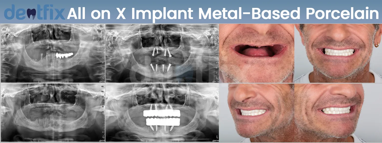All-on-4 / All-on-6 full-mouth implant before and after — X-ray and smile, Dentfix Istanbul