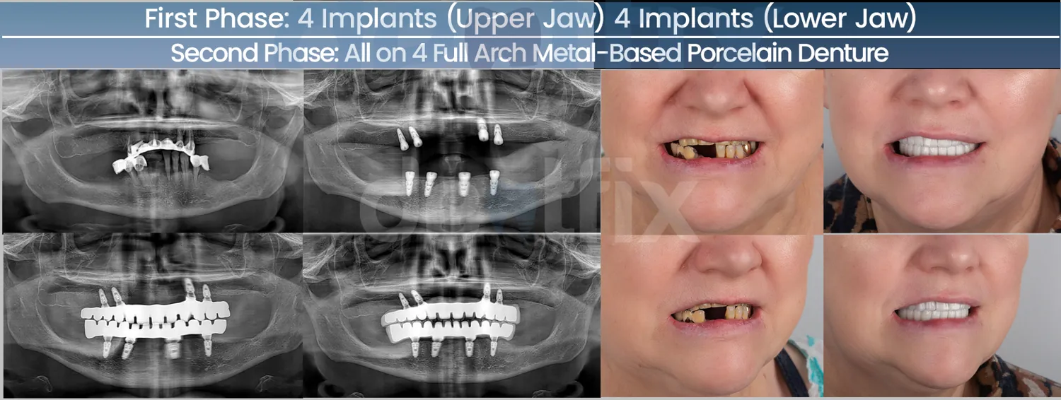 All-on-4 / All-on-6 full-mouth implant before and after — X-ray and smile, Dentfix Istanbul