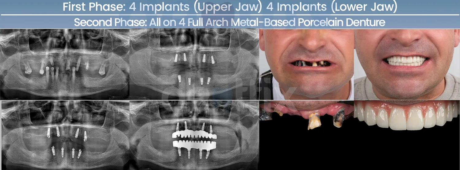 All-on-4 / All-on-6 full-mouth implant before and after — X-ray and smile, Dentfix Istanbul