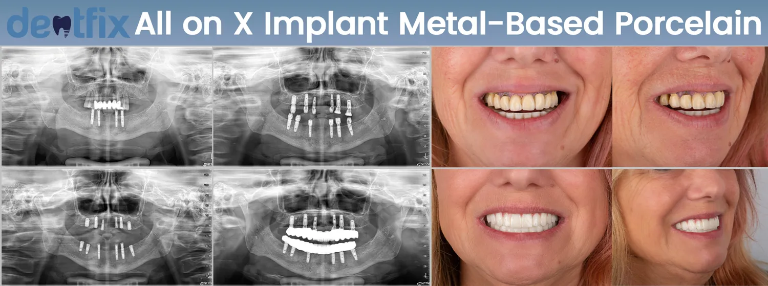 All-on-4 / All-on-6 full-mouth implant before and after — X-ray and smile, Dentfix Istanbul