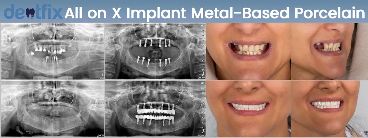 All-on-4 / All-on-6 full-mouth implant before and after — X-ray and smile, Dentfix Istanbul