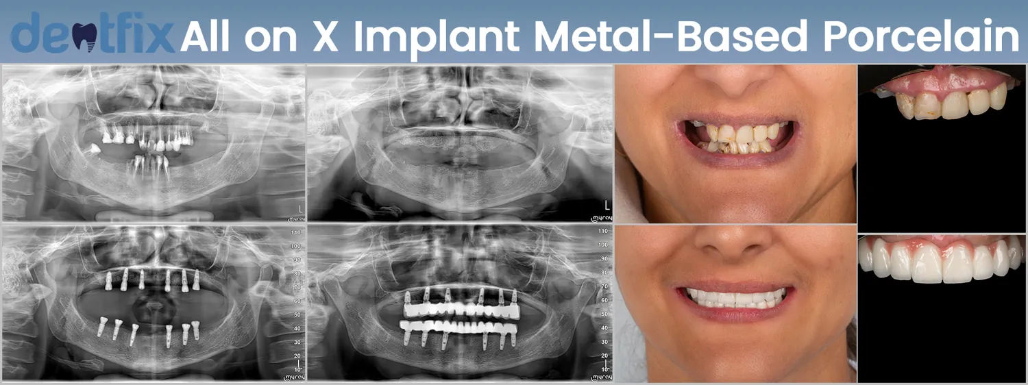 All-on-4 / All-on-6 full-mouth implant before and after — X-ray and smile, Dentfix Istanbul