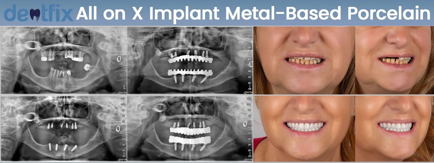 All-on-4 / All-on-6 full-mouth implant before and after — X-ray and smile, Dentfix Istanbul
