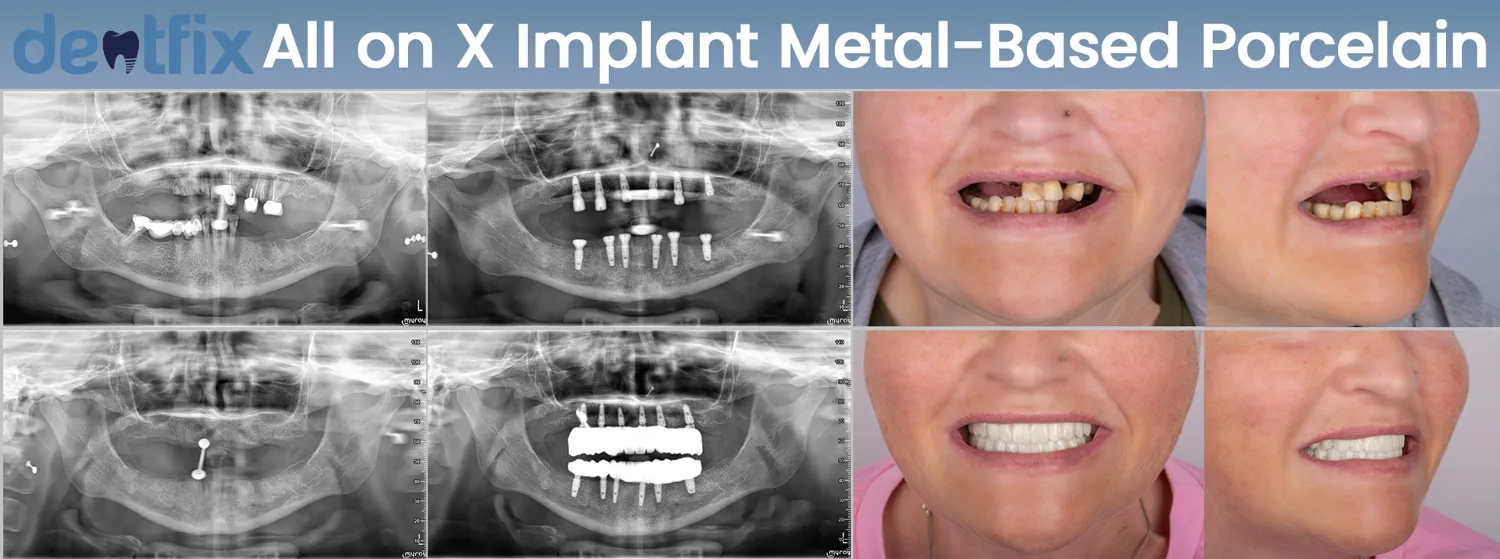 All-on-4 / All-on-6 full-mouth implant before and after — X-ray and smile, Dentfix Istanbul