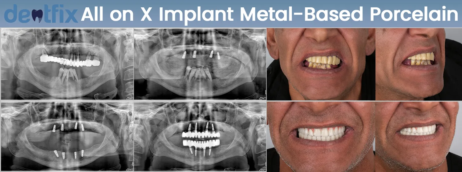 All-on-4 / All-on-6 full-mouth implant before and after — X-ray and smile, Dentfix Istanbul