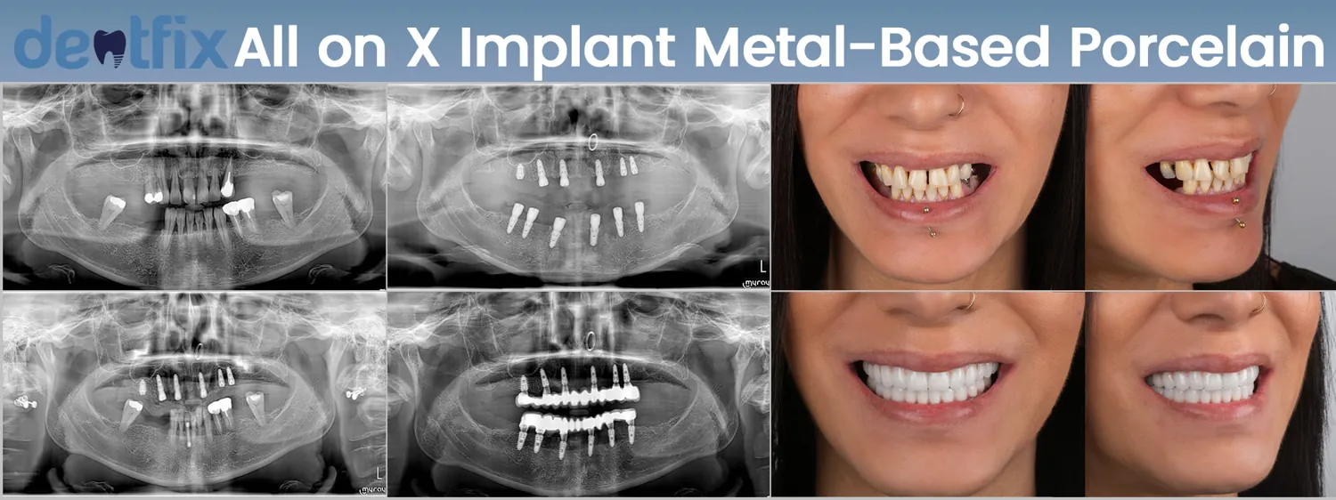 All-on-4 / All-on-6 full-mouth implant before and after — X-ray and smile, Dentfix Istanbul