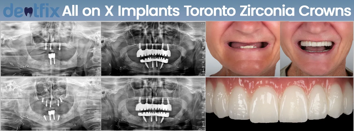 All-on-4 / All-on-6 full-mouth implant before and after — X-ray and smile, Dentfix Istanbul