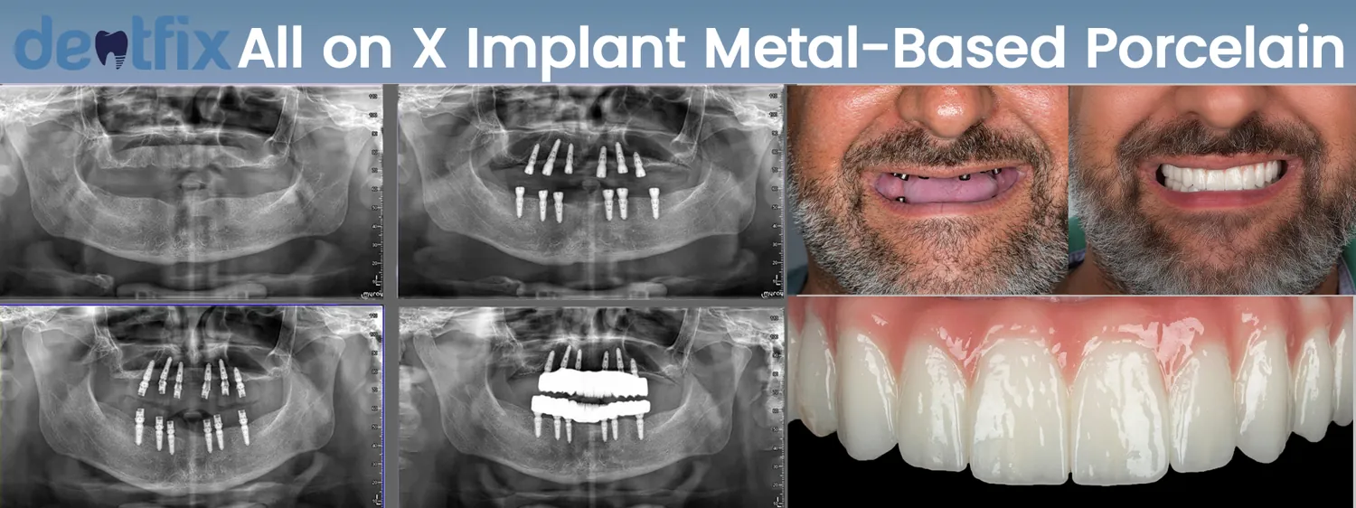 All-on-4 / All-on-6 full-mouth implant before and after — X-ray and smile, Dentfix Istanbul