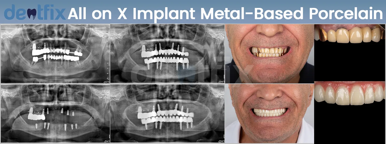 All-on-4 / All-on-6 full-mouth implant before and after — X-ray and smile, Dentfix Istanbul