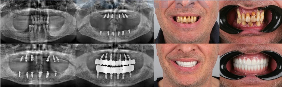 Real All-on-X case at Dentfix Istanbul, case 1 — before and after: 6 implants in the upper jaw and 6 in the lower, restored with a full-arch Toronto denture and zirconium crowns; panoramic X-rays included