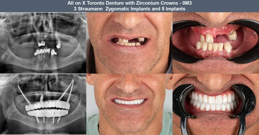Zygomatic implant case — before and after panoramic X-ray and smile: 3 Straumann zygomatic + 5 conventional implants · fixed full-arch zirconia bridge
