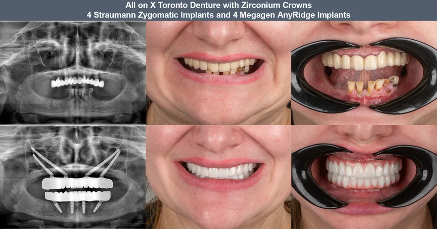 Zygomatic implant case — before and after panoramic X-ray and smile: 4 Straumann zygomatic + 4 Megagen implants · fixed full-arch zirconia bridge