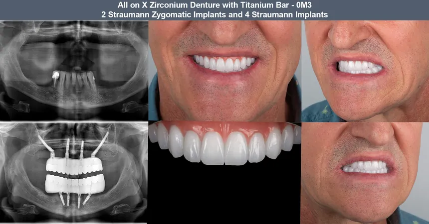 Zygomatic implant case — before and after panoramic X-ray and smile: 2 Straumann zygomatic + 4 Straumann implants · zirconia bridge on titanium bar