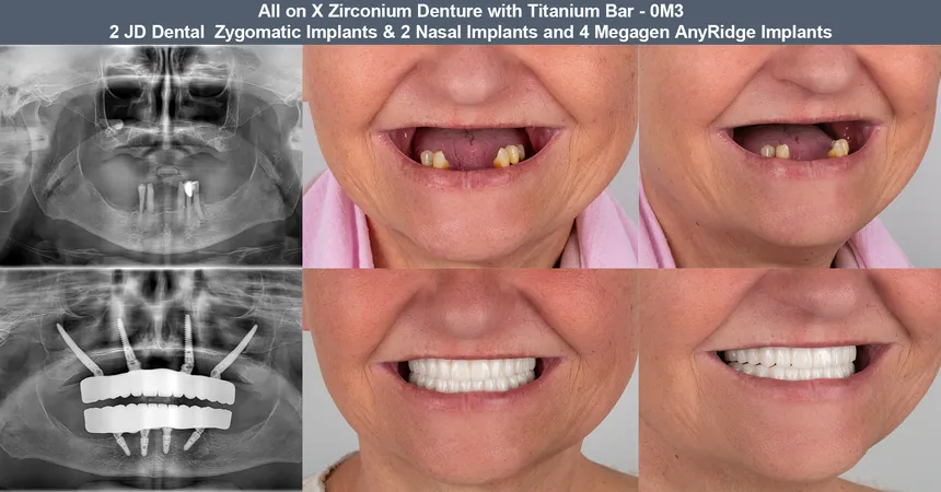 Zygomatic implant case — before and after panoramic X-ray and smile: 2 JD Dental zygomatic + 2 nasal + 4 Megagen implants · zirconia bridge on titanium bar