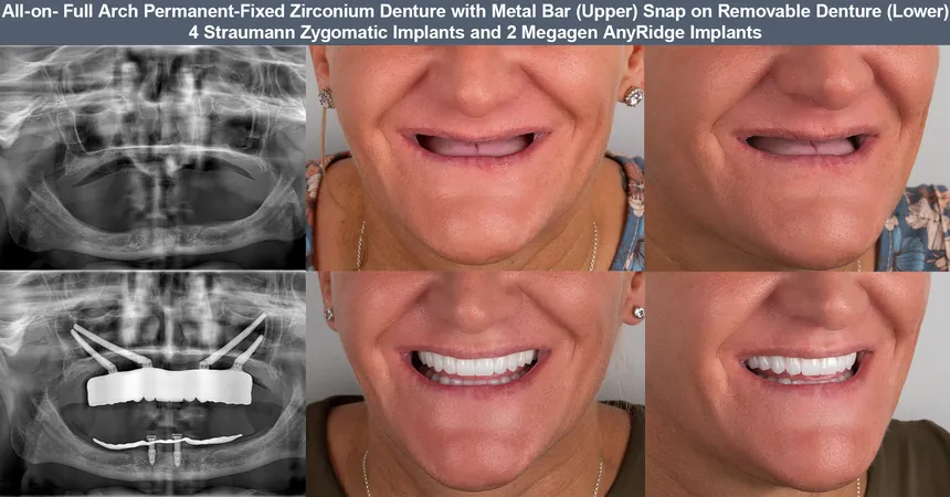 Zygomatic implant case — before and after panoramic X-ray and smile: 4 Straumann zygomatic + 2 Megagen implants · fixed zirconia upper on metal bar