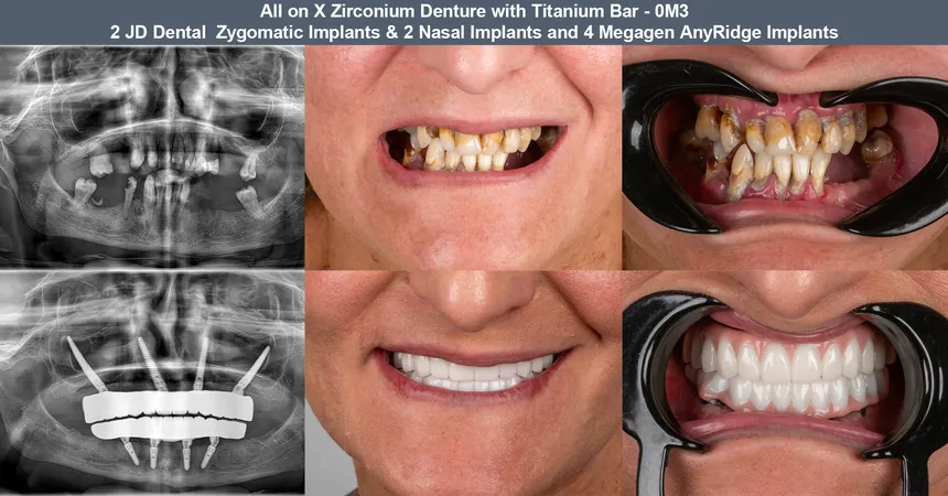 Zygomatic implant case — before and after panoramic X-ray and smile: 2 JD Dental zygomatic + 2 nasal + 4 Megagen implants · zirconia bridge on titanium bar
